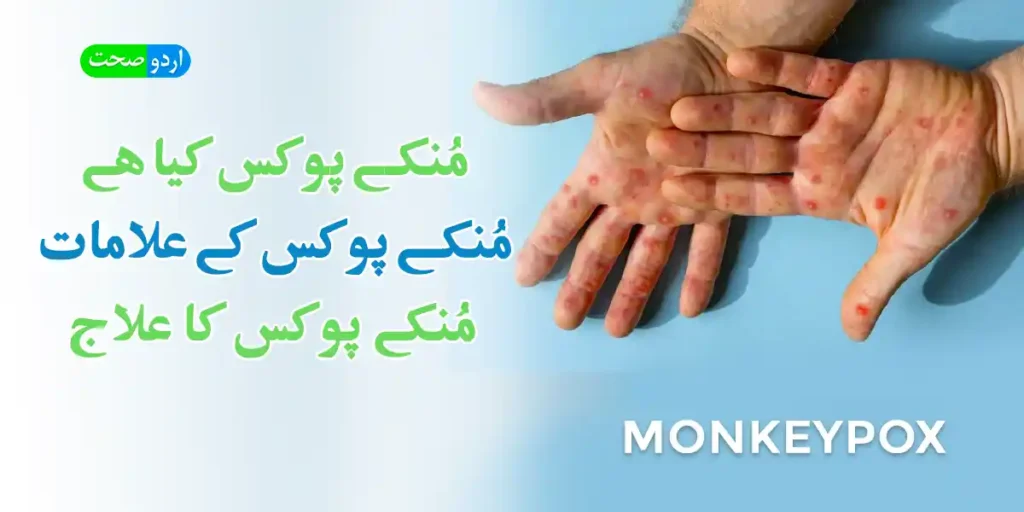 Monkeypox Symptoms in Urdu - مُنکے پوکس